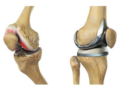 Knee Joint Replacement in Vijayawada