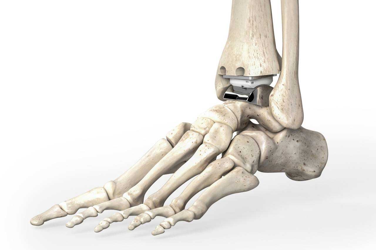 ankle replacement surgery in Vijayawada