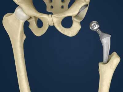 hip replacement surgery in vijayawada